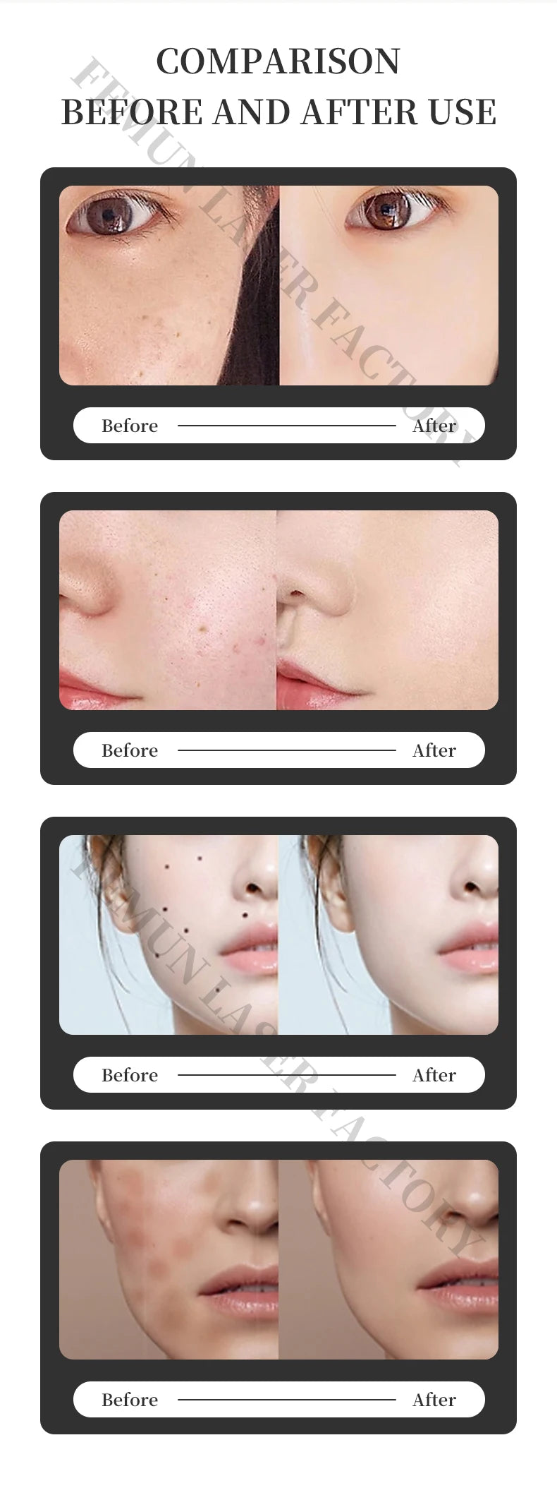 4-in-1 4000W Laser Hair Removal Machine – Painless 2025