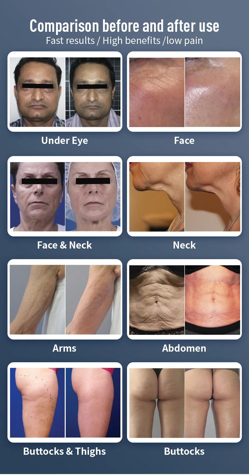 Venus Legacy 4DTM Pro Fat Burner Slimming, Firming Anti-Cellulite Fat Reduction Lift Anti-Aging Device Fat Lift Anti-Aging