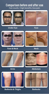 Venus Legacy 4DTM Pro Fat Burner Slimming, Firming Anti-Cellulite Fat Reduction Lift Anti-Aging Device Fat Lift Anti-Aging