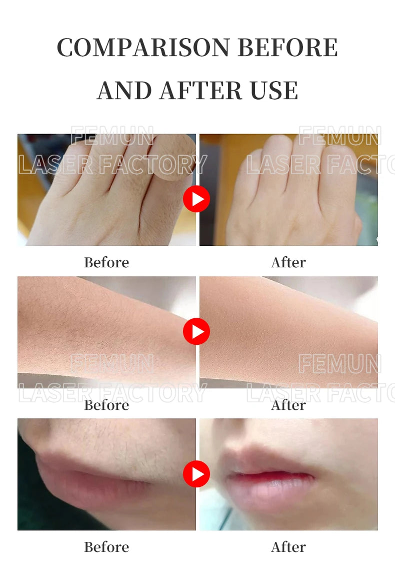 4-in-1 4000W Laser Hair Removal Machine – Painless 2025